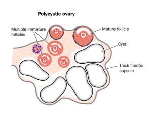 polycystic ovary as seen in PCOS