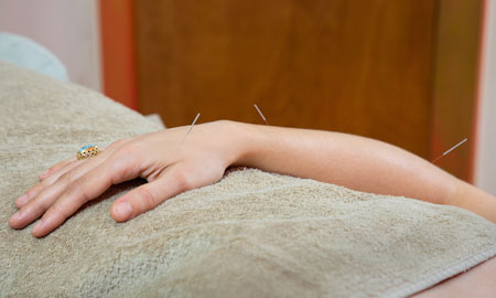 Arm with acupuncture needles